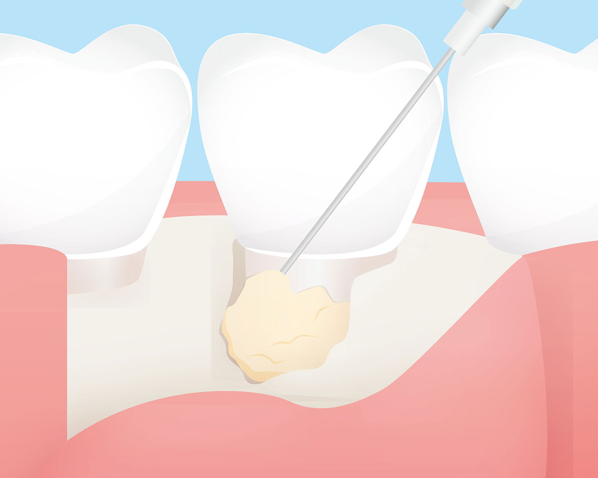 日本歯周病学会　歯周病専門医とは？